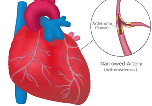 Heart-&-narrowed-artery