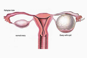 ovarian-cancer-from-cysts